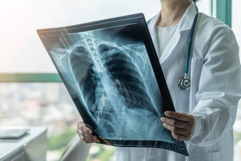 Doctor diagnosing patientâs health on asthma, lung disease, COVID-19 or bone cancer illness with radiological chest x-ray film for medical healthcare hospital service